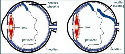 wat is netvliesloslating.